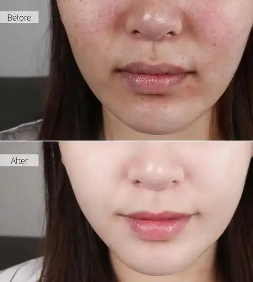 海绵微针前后肌肤对比