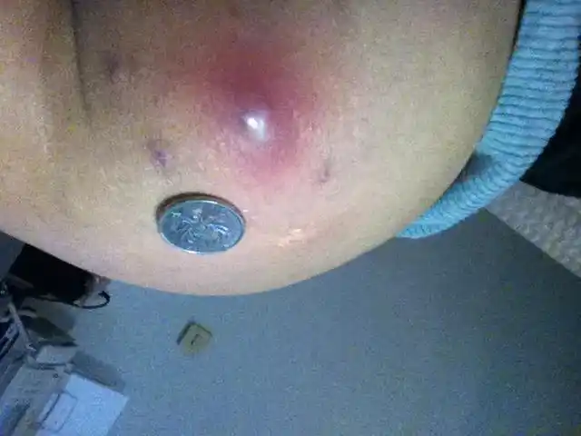 屁股上长火疖子图片