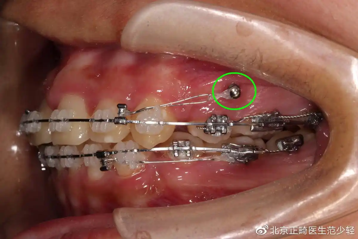 关于正畸种植钉,你想知道的都在这里