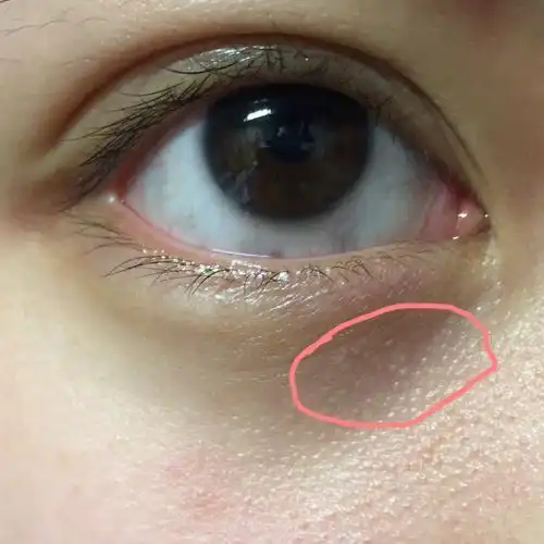 关于眼周有脂肪粒怎么去除的配图及描述