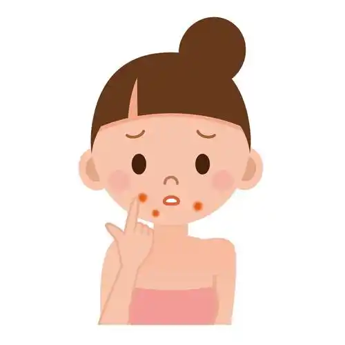 节后长痘痘怎么办_饮食_治疗_水杨酸