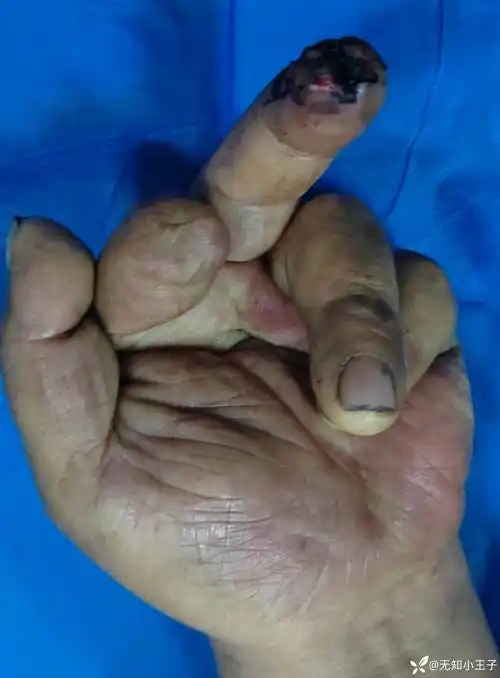 手指末端损伤后皮肤坏死怎么处理