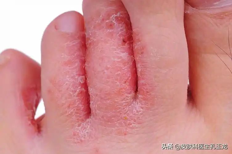 女生水泡型脚气图片,皮肤科医生和你聊脚气脚气为什么容易反复 - 玉