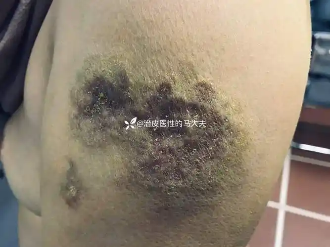 典型皮损狼疮性脂膜炎