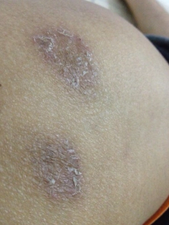 体癣图片_体癣症状表现图片大全_有来医生