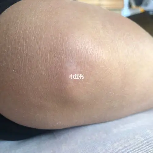 知道的可以看一下,但是现在基本好了,第一张是膝盖弯的时候疤痕的样子