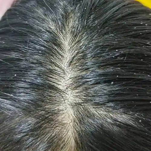 头发头皮有头屑用什么洗发水?适合孕妇的去屑洗发水__