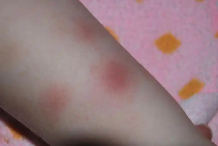 出现红斑图片腿上突然出现红斑图片腿上突然出现红斑图片深部红斑狼疮