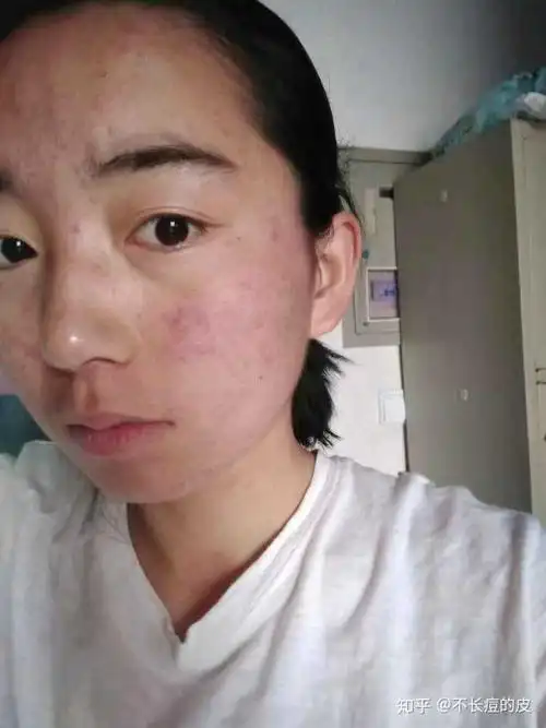 你是怎么从一个皮肤很差的女生改造过来的?