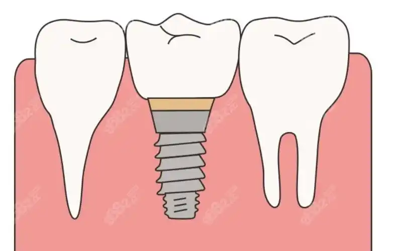 这是种植牙卡通图