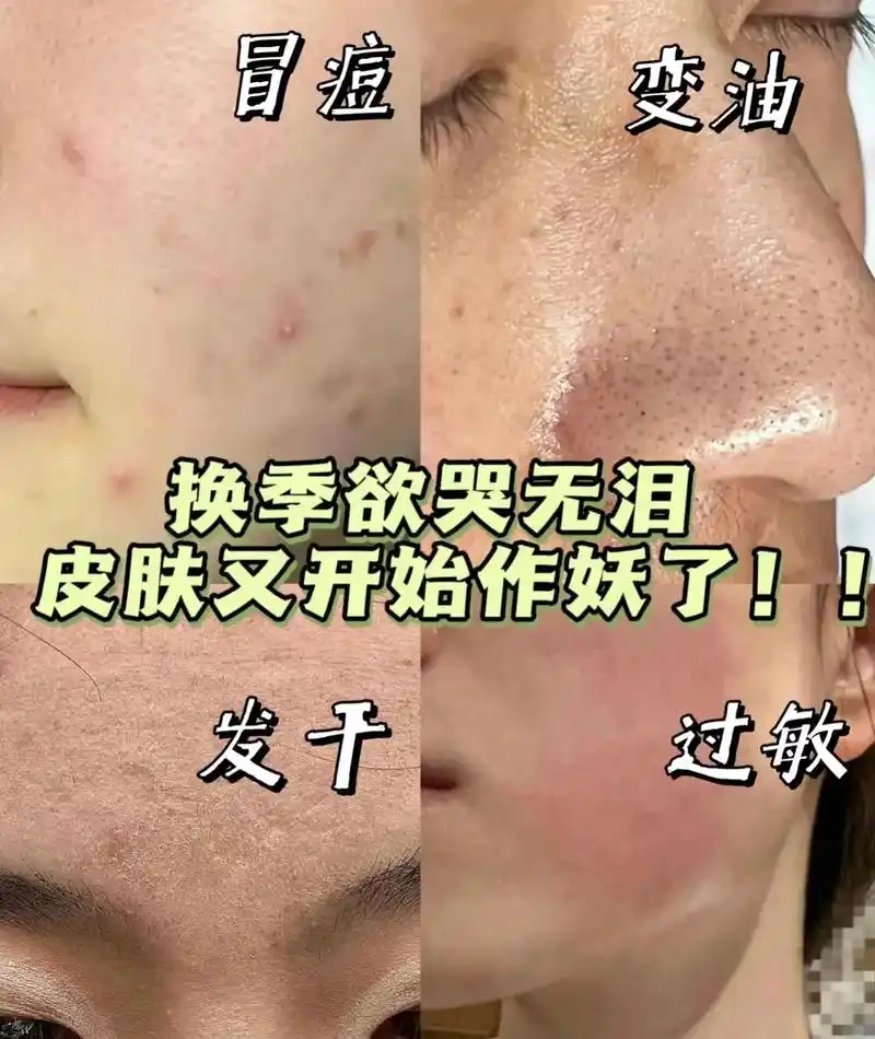 换季皮肤干燥脱皮处理方法.#好皮肤养出来 先用美肌霜,再用水 - 抖音