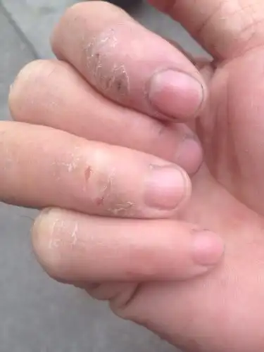 手指关节裂开,见热水特别痒,冬天温度下降了特别严重,曾擦过999皮炎平