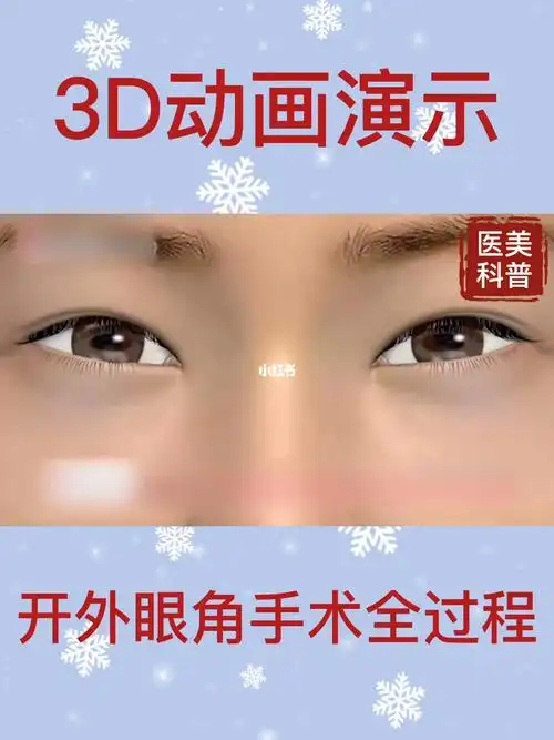 3d动画演示97开外眼角手术全过程73_动画_上海攻略_开眼角_美妆