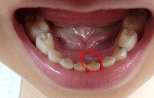10个孩子5个是双排牙,这是怎么回事呢?可能都是父母的错