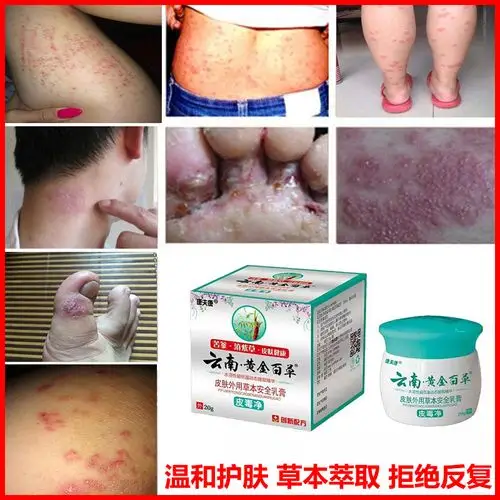 药店云南黄金百草膏治肛门潮湿屁眼痒的药男性女士屁股皮肤止痒膏