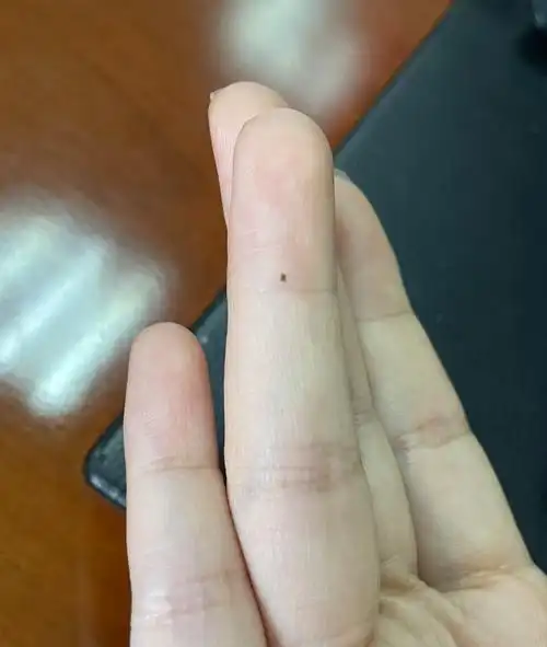 本人女左手无名指半年前多新长了一颗痣 有什么寓意? - 知乎