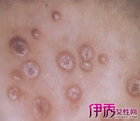 健康 正文 ②,淋病.