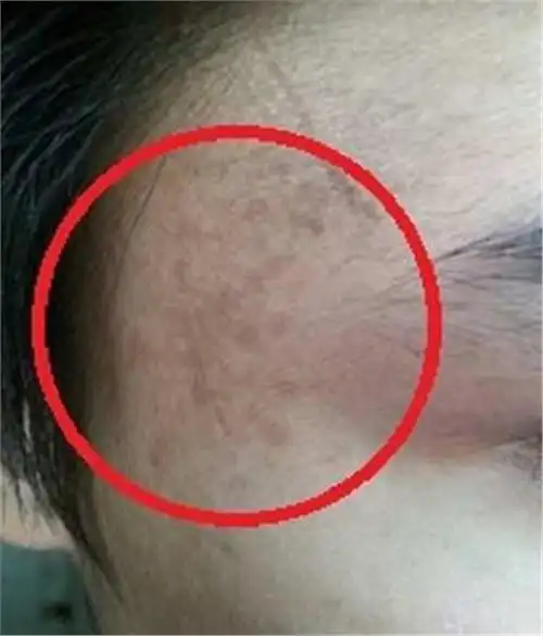 身上这3个地方长斑,暗示你肝病来了,早发现早治疗,别不在乎!