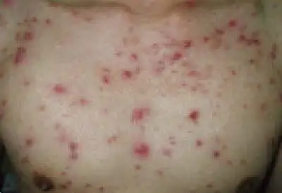 毛囊炎_症状表现_治疗方式 - 好大夫在线