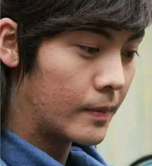 娱乐圈爆痘最严重男星金星第五王俊凯第三第一是陈伟霆