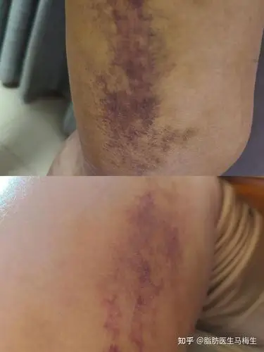 吸脂术后遗症发生概率排名第一的是