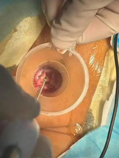 桂林市中西医结合医院肛肠科在桂北地区率先开展痔疮射频消融治疗