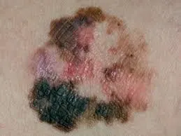 皮肤癌的症状图片大全