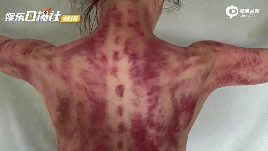 视频:48岁郑秀文晒背部刮痧照 好友看呆