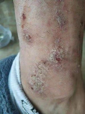 肛门瘙痒屁眼痒男性牛皮癣止痒膏 3送2芙必治癣毒康药膏17g皮肤瘙