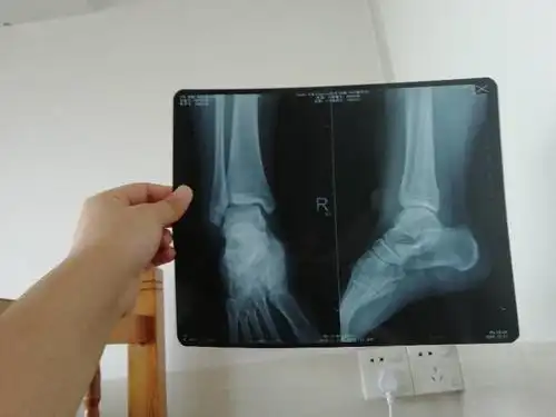 12月22日扭到脚,医生说休息两个星期 现在2.