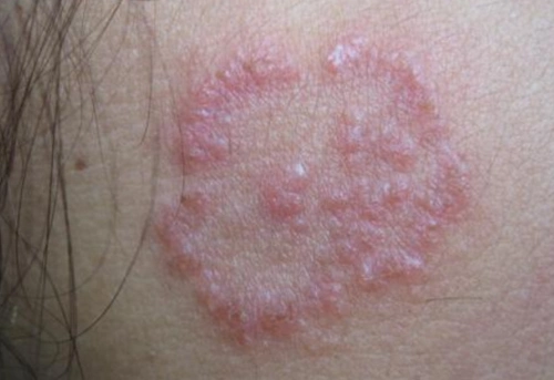 体股癣初期现象图片8