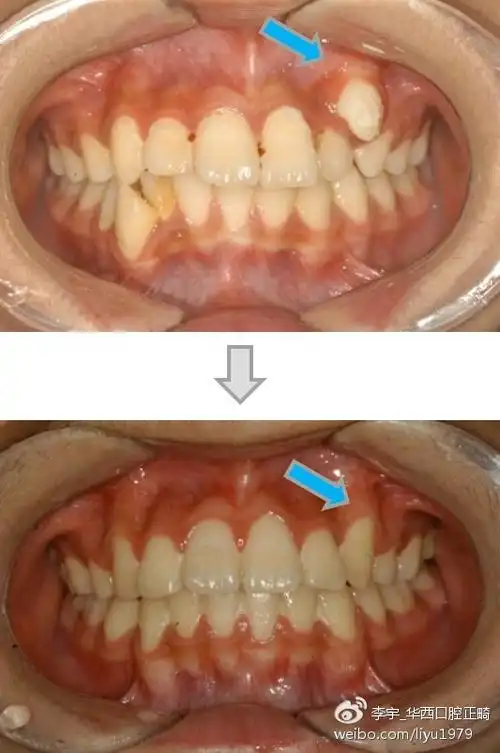 典型的"虎牙"矫治后牙根过于唇侧