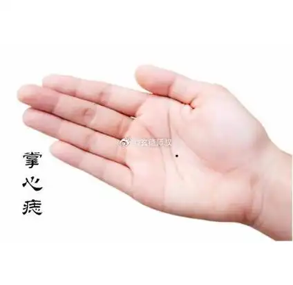 痣在手心,象征富贵;痣在手背,代表才情.