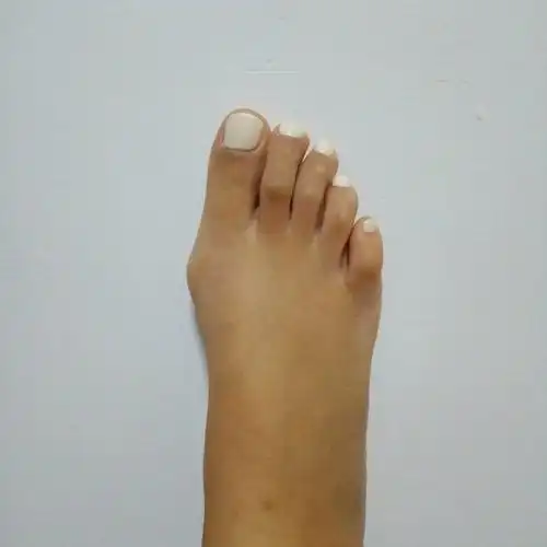 第一:有没有必要做拇指外翻手术?第二:小脚趾应该做什么矫正?