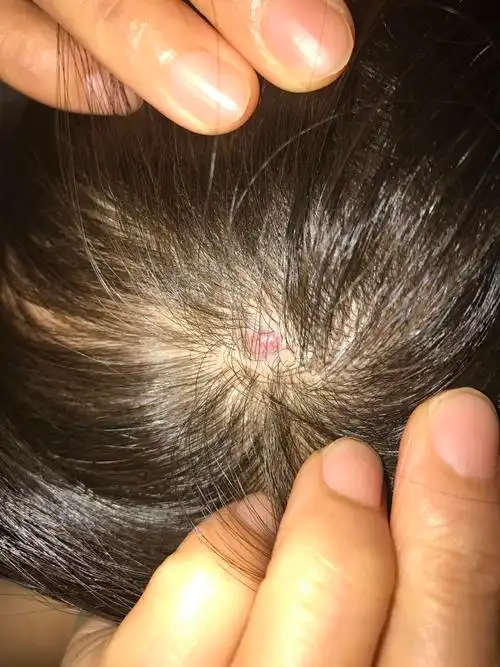 头皮上长了个疙瘩红色的