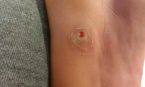 今天终于把鸡眼拔出来了 ,拔出来的那一刻特别特别的疼,不过不知道干