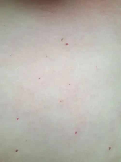 前胸小红点,这是什么情况,不疼不痒,没感觉