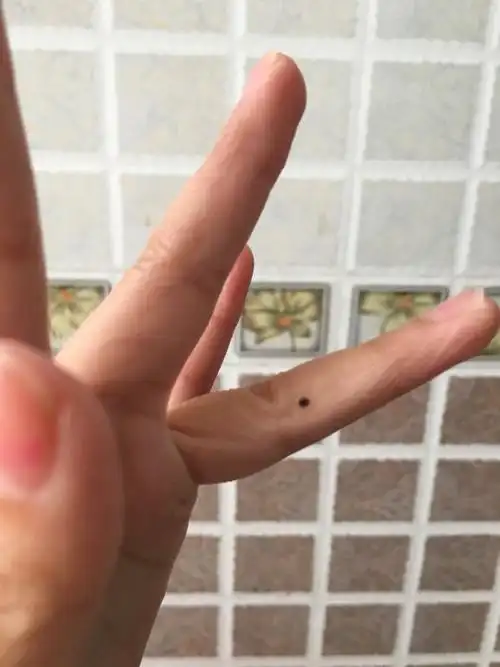 我是女生 无名指侧边长了一颗黑色素的痣 长了一两年 现在一看比以前