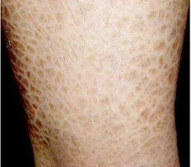 3,寻常型鱼鳞病:此类鱼鳞病的症状主要表现在四肢伸侧和躯干的燥性