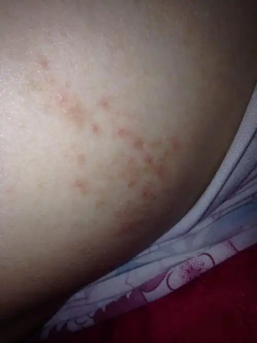 孕妇肚子上有红色斑点,这种是什么情况,严重吗?