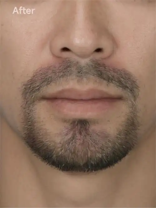 男性胡须艺术种植