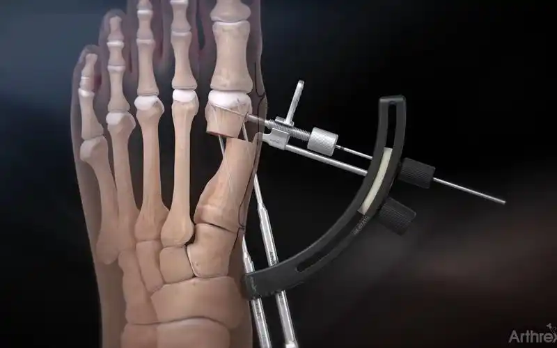 拇外翻的一种截骨治疗方法