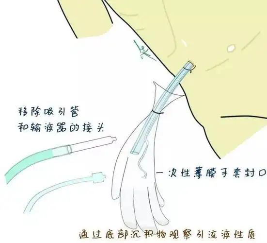 多图教你轻松搞定腹腔引流管冲洗