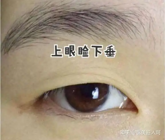 轻度上睑下垂需要做手术吗不做会严重吗