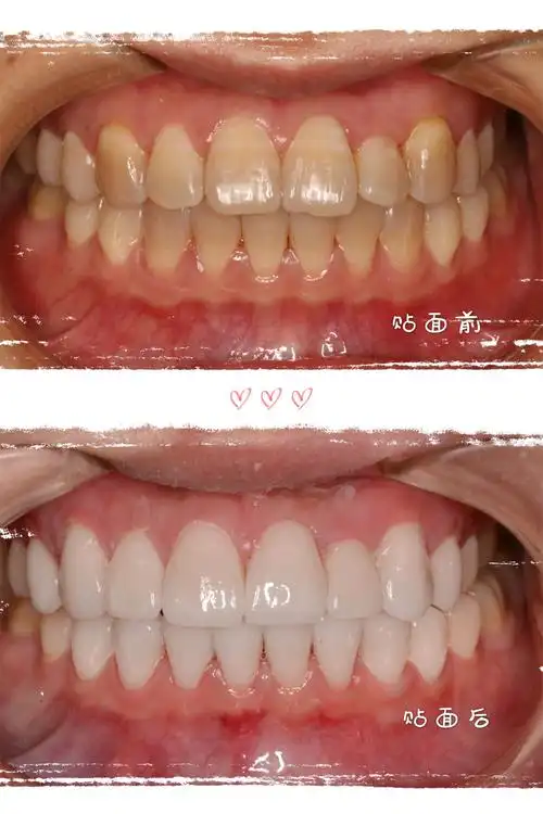 说说牙齿贴面 牙贴面是牙齿美白修复手术的一种,就是在本来染色牙葺