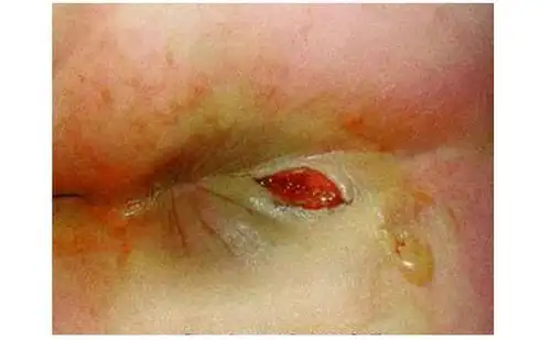 肛瘘的典型症状有哪些?