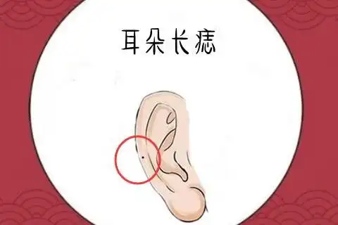 耳朵有痣好不好 耳朵有痣的含义