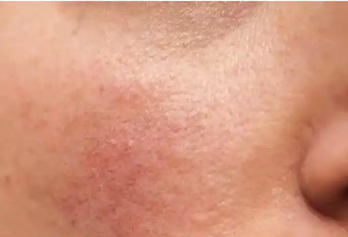 皮肤屏障受损怎么办护肤做好这几步是关键坚持才有效哦