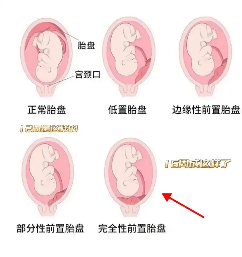 16周得知完全性前置胎盘 得知自己完全性前置胎盘,医生告知我,是真的