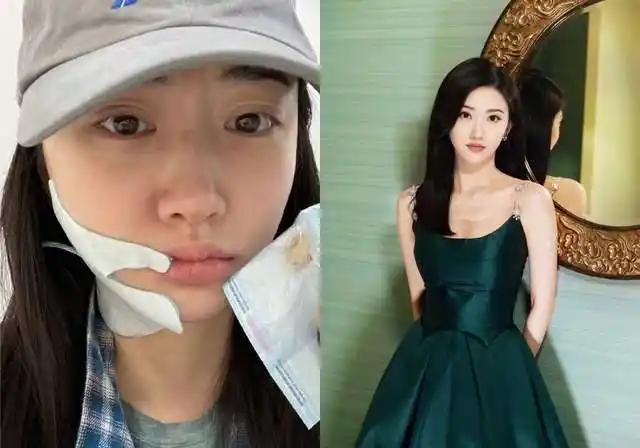 33岁景甜拔牙后晒素颜照,嘴唇干裂表情委屈,脸肿仍然不惧出镜_照片